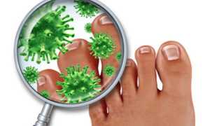 Грибковое поражение ногтей на ногах