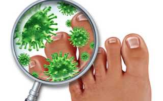 Грибковое поражение ногтей на ногах