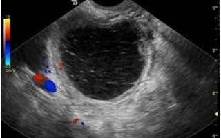 Гиперэхогенное образование в матке: причины и признаки, что делать?