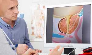 ТРУЗИ простаты — подготовка и показания к проведению процедуры