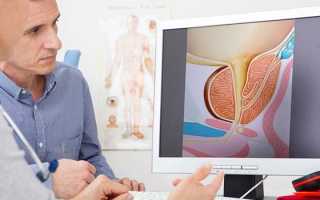 ТРУЗИ простаты — подготовка и показания к проведению процедуры