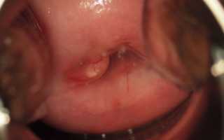 Прижигание кисты шейки матки: подробное описание процедуры