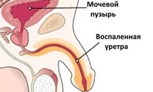 Жжение при мочеиспускании у мужчин — причины и лечение