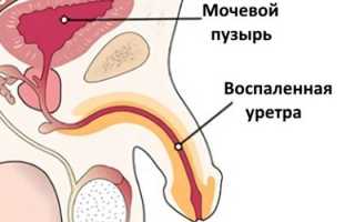 Жжение при мочеиспускании у мужчин — причины и лечение
