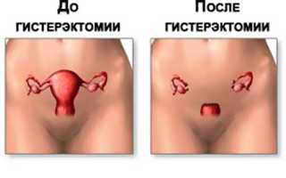 Как проводится лапаротомическая гистерэктомия?