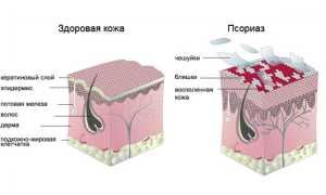 Всё о псориазе: симптомы, диагностика и советы по лечению