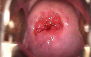 Опасен ли децидуоз шейки матки при беременности?