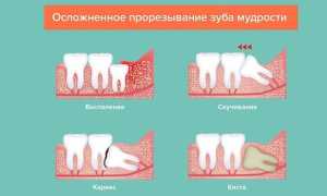 Особенности прорезывания и удаления зубов мудрости