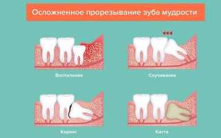 Особенности прорезывания и удаления зубов мудрости