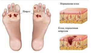 Гангрена — причины возникновения, виды и методы лечения