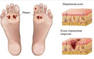 Гангрена — причины возникновения, виды и методы лечения
