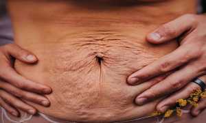 Уход за кожей живота после родов