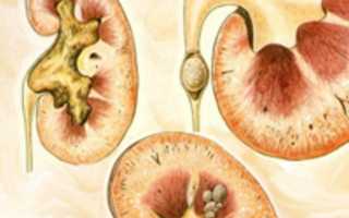 Удаление камней из мочевого пузыря • Русский Доктор