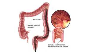 Тубулярная аденокарцинома желудка: формы заболевания и лечение