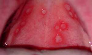 Фарингит у детей: симптомы и лечение