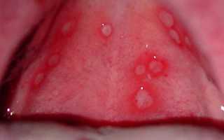 Фарингит у детей: симптомы и лечение