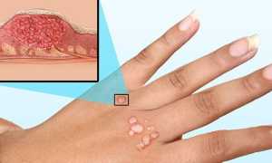 Типы вируса папилломы человека — классификация по онкогенности