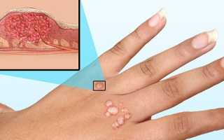 Типы вируса папилломы человека — классификация по онкогенности