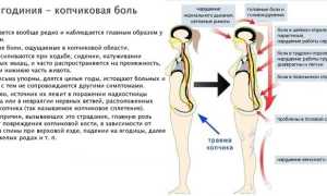 Кокцигодиния — причины болей, симптомы и лечение
