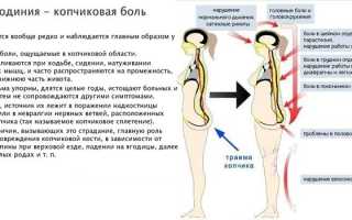 Кокцигодиния — причины болей, симптомы и лечение