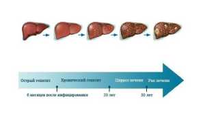 Лечение гепатита С — схема комплексной терапии и список эффективных препаратов