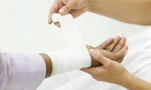 Облепиховое масло от ожогов