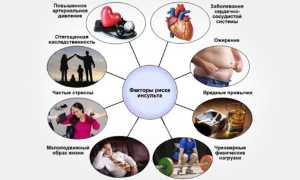 Ишемический инсульт головного мозга — причины, симптомы и лечение