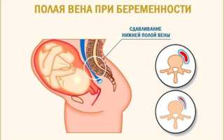 Синдром сдавления нижней полой вены при беременности