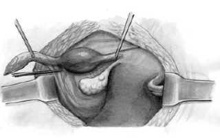 Когда проводится лапаротомия при внематочной беременности?