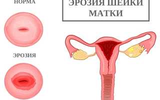 Противопоказания при эрозии шейки матки: спорт, образ жизни и др.