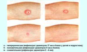 Прививка БЦЖ от туберкулёза: график вакцинации, инструкция, реакция, цены