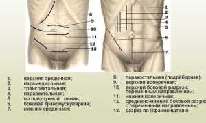 Лапаротомия — виды операции, показания и техника проведения