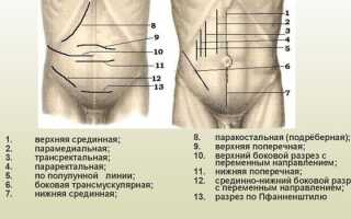 Лапаротомия — виды операции, показания и техника проведения