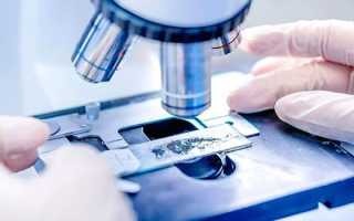 Трихомониаз — пути заражения, симптомы, диагностика и лечение