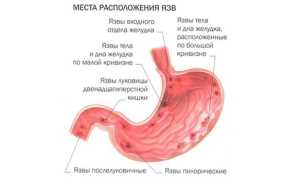 Классификация язвенной болезни желудка — виды и их симптомы