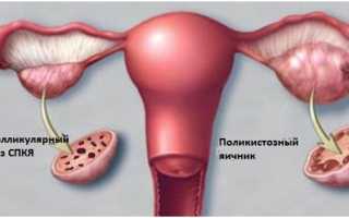 Возможна ли овуляция при мультифолликулярных яичниках?