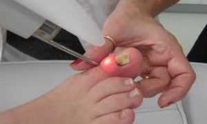 Симптомы, отличающие грибок ногтей от псориаза ногтей