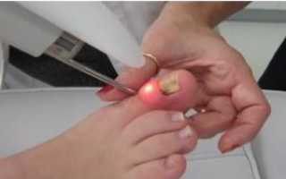 Симптомы, отличающие грибок ногтей от псориаза ногтей