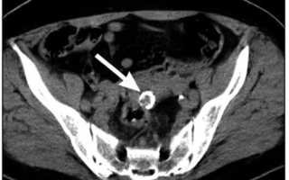 Что такое кальцинированная миома матки?
