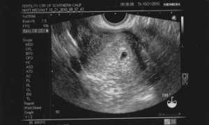 Когда появляются первые признаки беременности после зачатия?