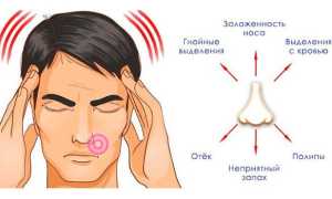Последствия гайморита у взрослых — нарушение работы органов дыхания и систем организма