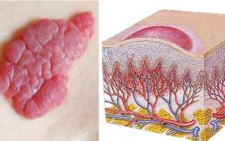 Причины, симптомы и лечение гемангиом