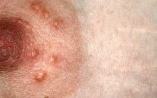 Что такое бугорки Монтгомери при беременности – фото