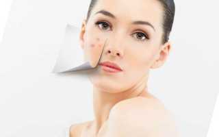 Особенности диагностики и лечения псориаза на лице