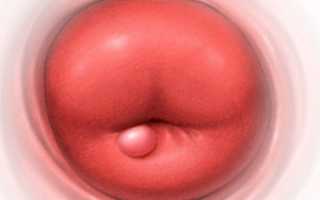 Что такое эндометриоидная киста шейки матки?