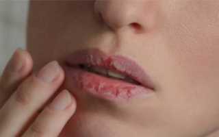 Почему сохнут губы — основные причины и способы лечения