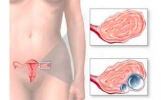 Как выходит киста яичника во время месячных: какие симптомы на это указывают?