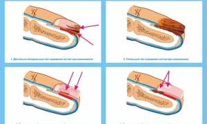 Классификация и виды грибка ногтей на ногах — способы лечения