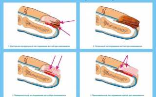 Классификация и виды грибка ногтей на ногах — способы лечения
