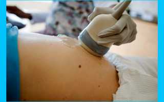 Базальная температура при внематочной беременности